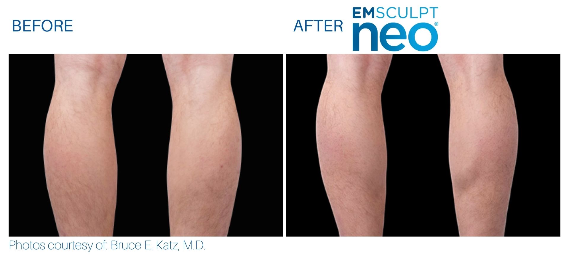 EmSculpt NEO Muscle Building & Fat Burning as low as €300 per session